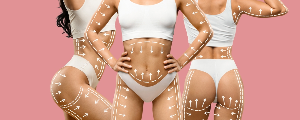 Women showcasing body contouring results with arrows indicating treatment areas, emphasizing non-invasive body sculpting techniques offered by Superior Sculpting in Vero Beach, FL.